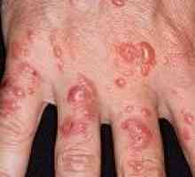 Aktinická dermatitida: příčiny, příznaky, léčba