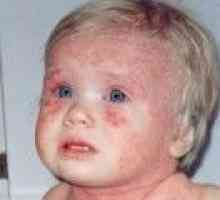 Atopické dermatitidy u dětí, příznaky a léčba