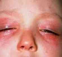 Alergie na očích, jak se projevuje? Jak se chovat?