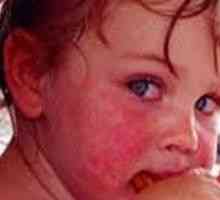 Alergický na sladké u dětí, u dospělých, léčba