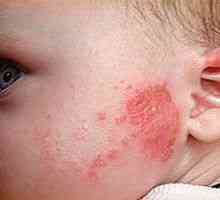 Alergie u dětí, příčiny, příznaky, léčba