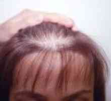 Androgenní alopecie u žen, příznaky, léčba