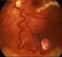 Sítnice angiomatózy oči