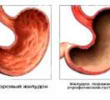 Antrální atrofická gastritida: příčiny, příznaky, léčba