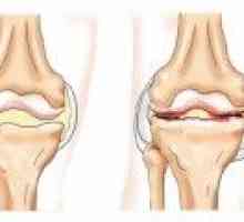 Kolenního kloubu artritida: symptomy, příčiny, léčba