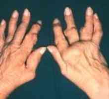 Artritida kloubů prstů: příznaky a léčba