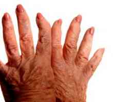 Osteoartritida prstech, příznaky a léčba