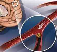 Mozková ateroskleróza