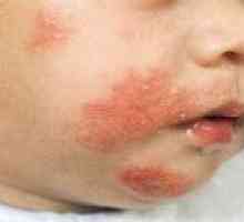 Atopická dermatitida u dětí - Příznaky, léčba