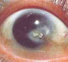 Trnem v oku: její příčiny, typy a léčba
