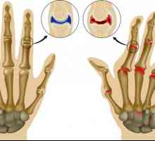 Biologická léčba revmatoidní artritidy: léčba a léky