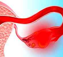 Co je ovariální apoplexie, příznaky a léčba