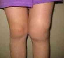 Deformující artróza kolenního kloubu