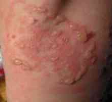 Dermatitida Duhring děti