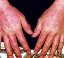 Diagnostika a léčba alergické dermatitidy