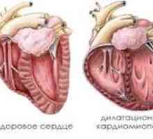 Dilatační kardiomyopatie, příčiny, příznaky, léčba