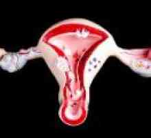 Dysfunkční děložní krvácení: příčiny, léčba