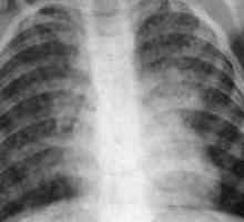 Šířeny tuberkulóza: příčiny, příznaky, léčba