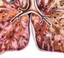 Šířeny tuberkulóza: příznaky, léčba