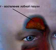 Zánět vedlejších nosních dutin: příznaky, léčba