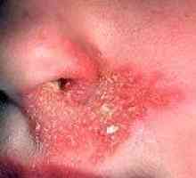 Opary v nose, pod nosem: Příčiny, léčba