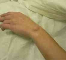 Hygrom zápěstí, ruce, joint - léčba hygrom