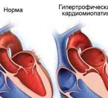 Hypertrofické kardiomyopatie, příčiny, příznaky, léčba