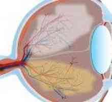 Glaukom - Prevence a léčba glaukomu