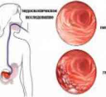 Chronická atrofická gastritida: příčiny, příznaky, léčba