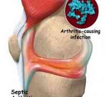 Infekční artritidy