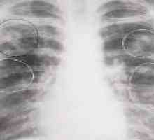 Infiltrativní plicní tuberkulóza: symptomy, fáze, léčba