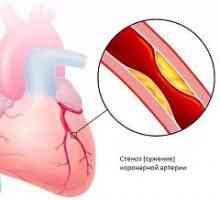 Ischemická choroba srdeční