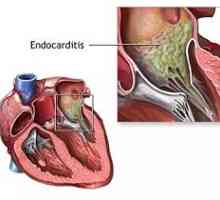 Endokarditida