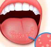 Enterovirus stomatitida, příčiny, léčba