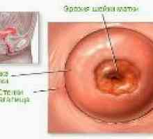 Cervikální eroze v rodící - příčiny a léčba