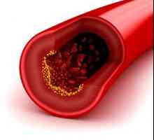 Jak rychle snížit cholesterol lidových opravné