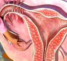 Jak léčit syndrom polycystických vaječníků