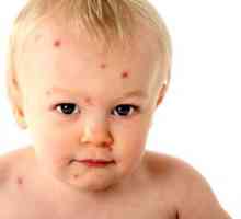 Jak se plané neštovice u dětí