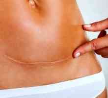 Jak odstranit žaludek po císařském řezu
