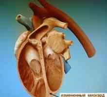 Kardiomyopatie
