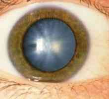 Šedý zákal - jedna z nejčastějších očních onemocnění