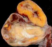 Cysta na vaječníku žluté tělísko: příznaky a léčba