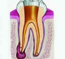 Zubní cysta
