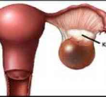 Cystoma (vpravo, vlevo), vaječníků - příčiny, léčba