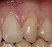 Zuby defekt ve tvaru klínu