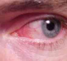 Zánět spojivek nebo červených očí: příznaky, léčba
