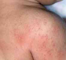 Kožní alergie: příčiny, příznaky, léčba
