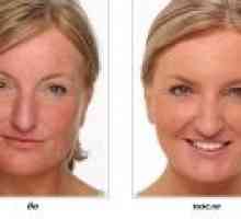 Laserové odstranění růžovky na obličeji