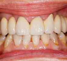 Léčba parodontu lidových onemocnění opravných: nejúčinnějším způsobům