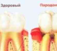 Léčba onemocnění parodontu doma